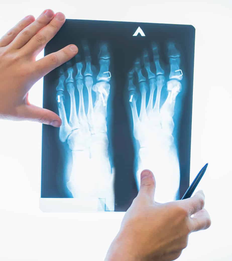 A person holding a pen and x-ray of feet. A person holding a pen and x-ray of feet.